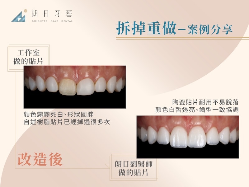 工作室做的樹脂貼片顏色霧白、形狀圓胖且多次脫落；朗日劉醫師拆除重做陶瓷貼片不易脫落、顏色自然透亮且齒型一致協調