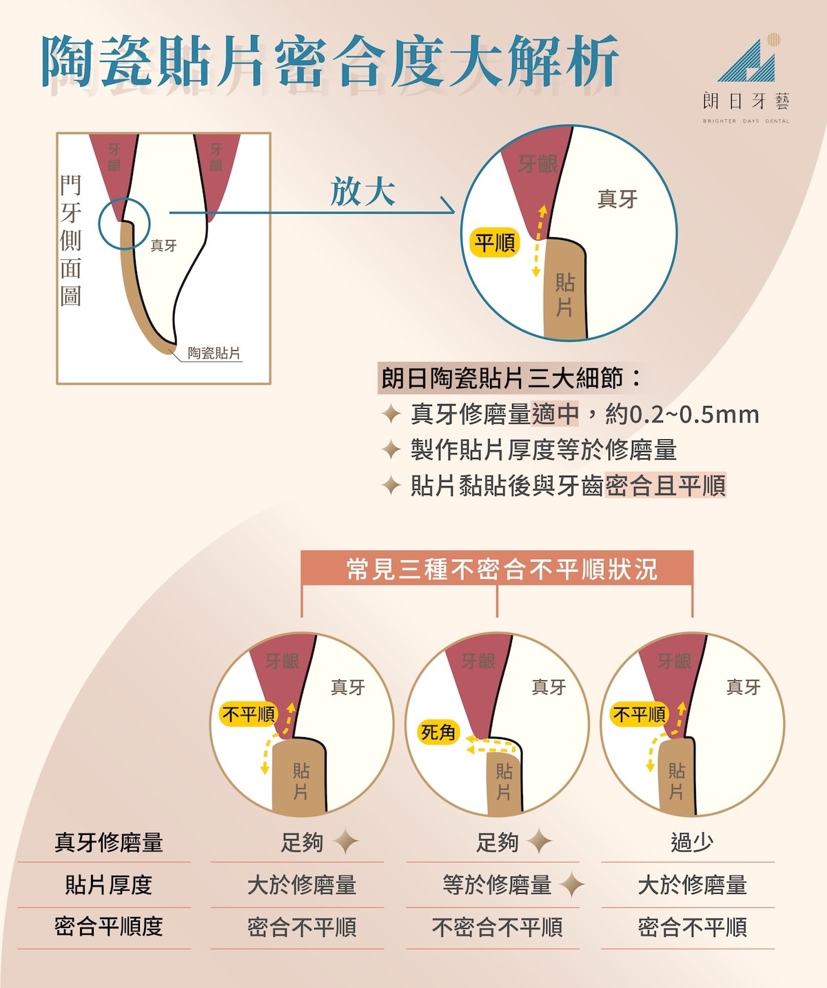磨牙量掌握不當影響陶瓷貼片密合度示意圖，貼片厚度與修磨量不符恐致接縫不平順或死角；朗日陶瓷貼片精準控制磨牙量，貼片與牙齒密合且平順，降低後遺症風險