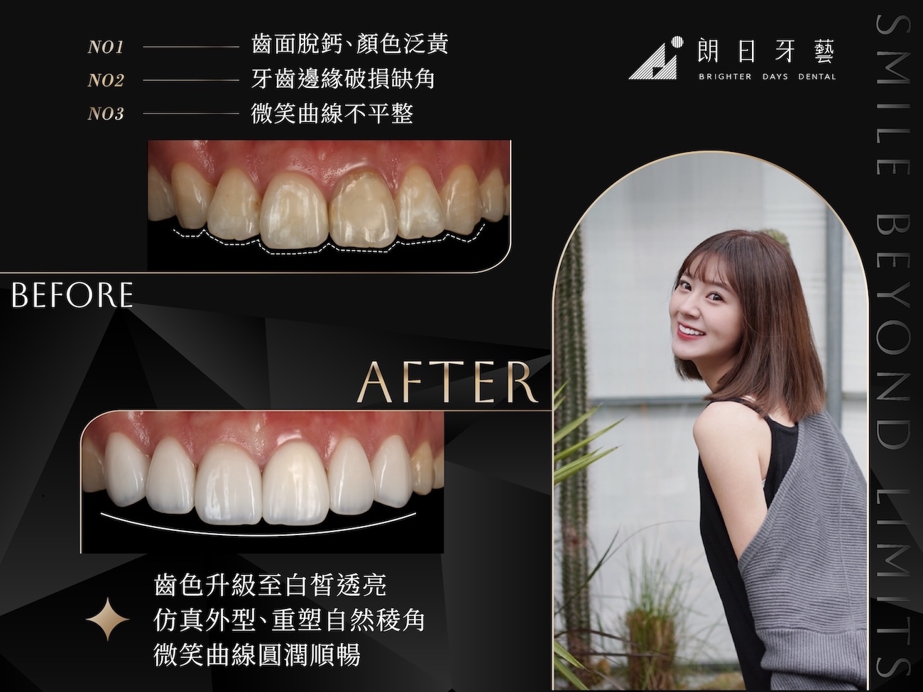 陶瓷貼片療程前牙齒黃、邊緣缺角與微笑曲線不整,療程後牙色白皙透亮、牙型自然圓潤,微笑線對稱順暢