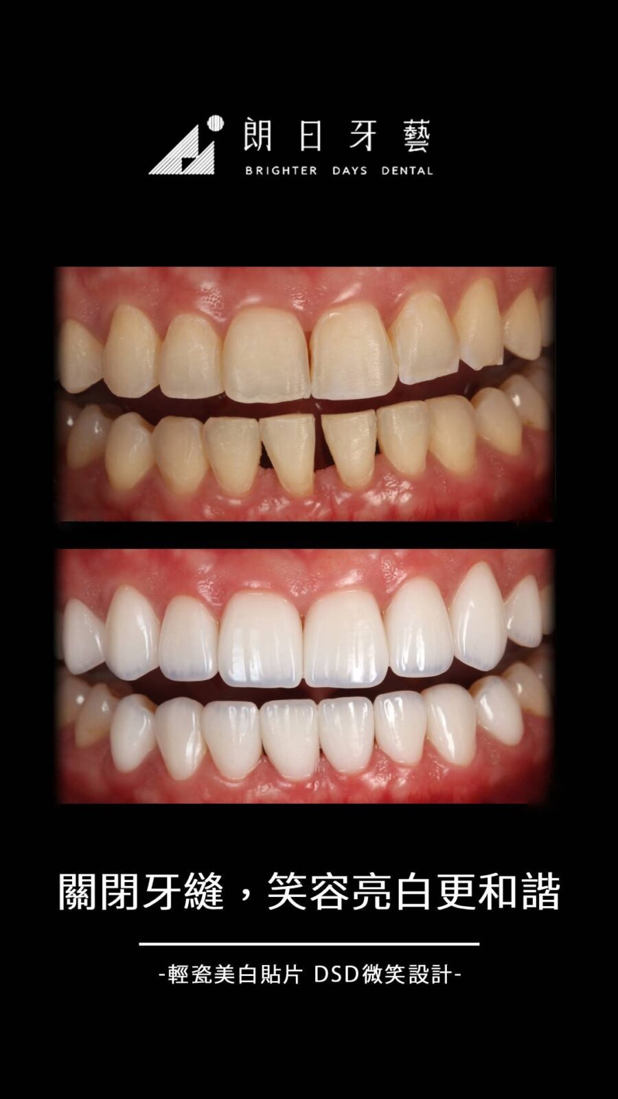 陶瓷貼片案例-下排牙縫大-台中朗日牙藝-輕瓷美白貼片