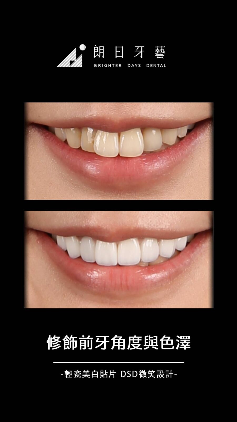 陶瓷貼片案例-前牙突出-牙齒黃-台中朗日牙藝-輕瓷美白貼片