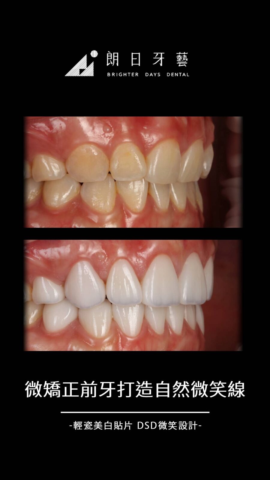 陶瓷貼片案例-微矯正前牙-台中朗日牙藝-輕瓷美白貼片