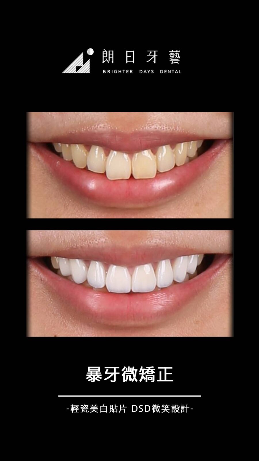 陶瓷貼片案例-暴牙微矯正-台中朗日牙藝-輕瓷美白貼片