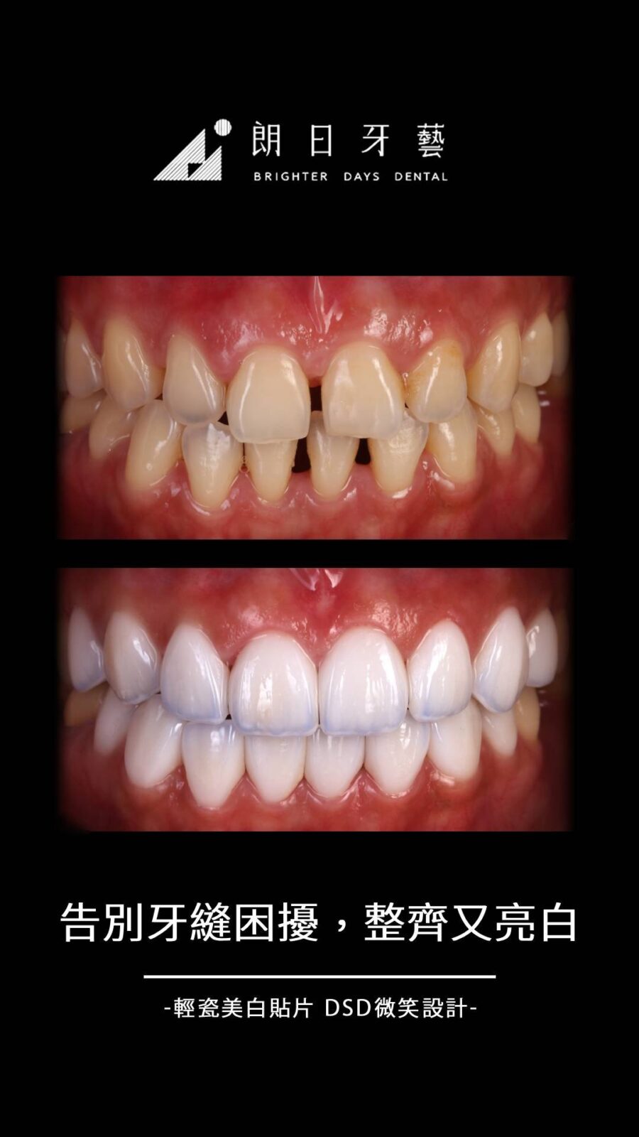 陶瓷貼片案例-牙縫大-台中朗日牙藝-輕瓷美白貼片