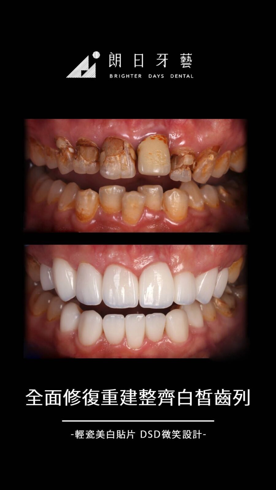陶瓷貼片案例-牙齒亂-嚴重牙齒變色-台中朗日牙藝-輕瓷美白貼片