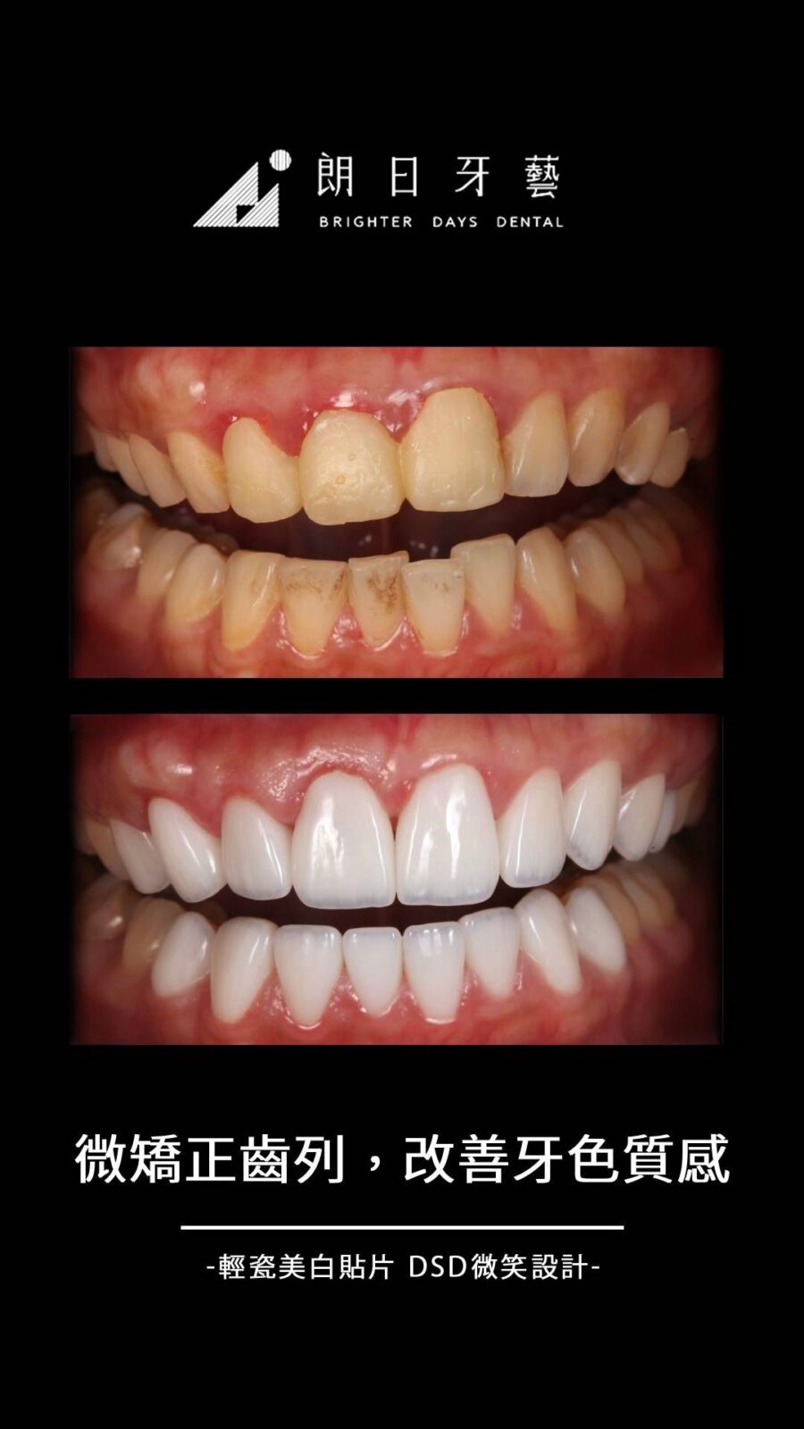 陶瓷貼片案例-牙齒亂-牙齒染色-台中朗日牙藝-輕瓷美白貼片