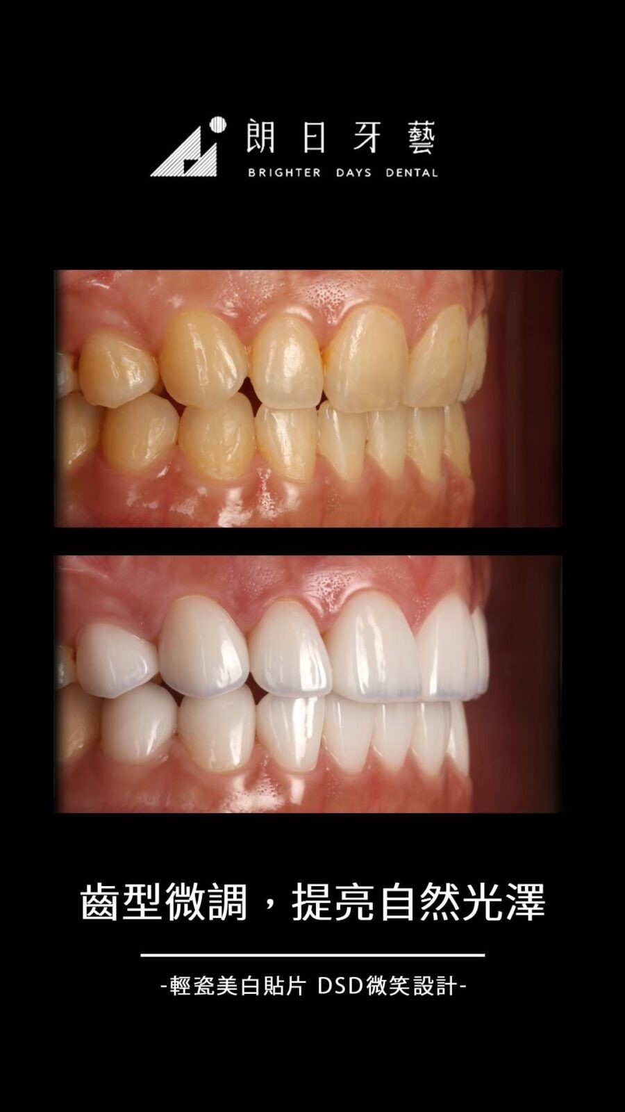 陶瓷貼片案例-牙齒平-齒色不均-台中朗日牙藝-輕瓷美白貼片