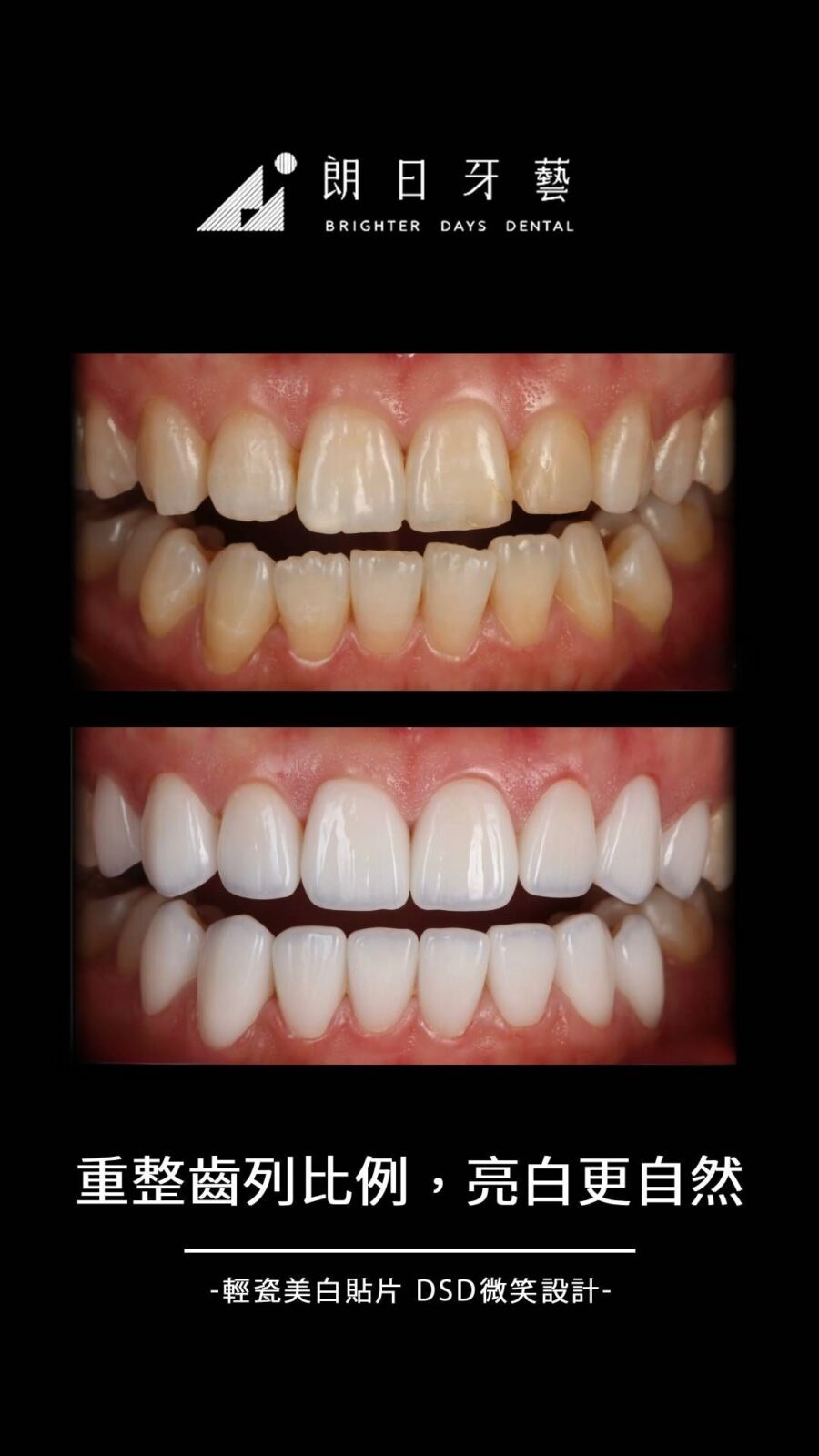 陶瓷貼片案例-牙齒擁擠-牙齒重疊-牙齒磨損-台中朗日牙藝-輕瓷美白貼片