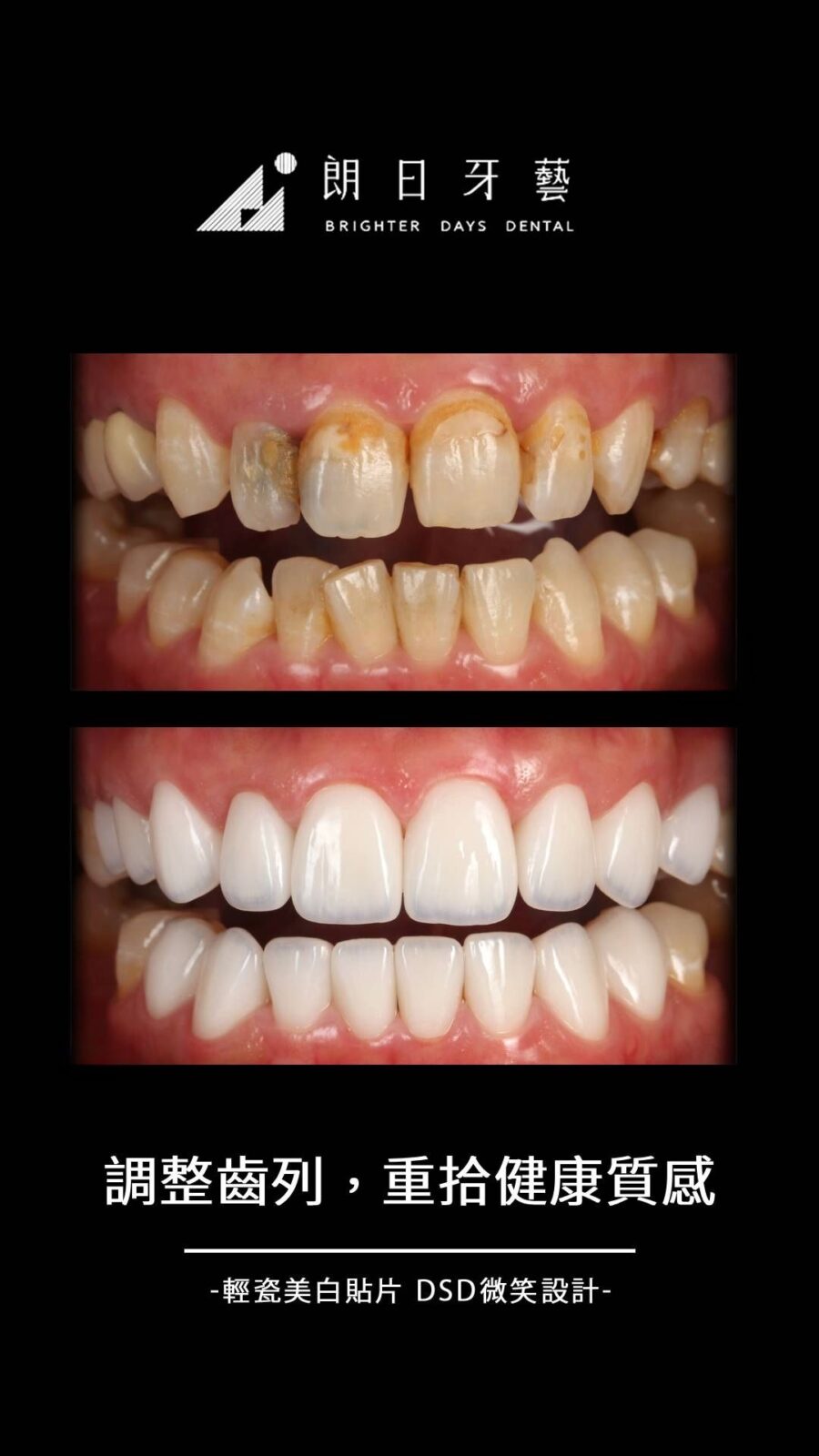 陶瓷貼片案例-牙齒破損-牙齒染色-台中朗日牙藝-輕瓷美白貼片