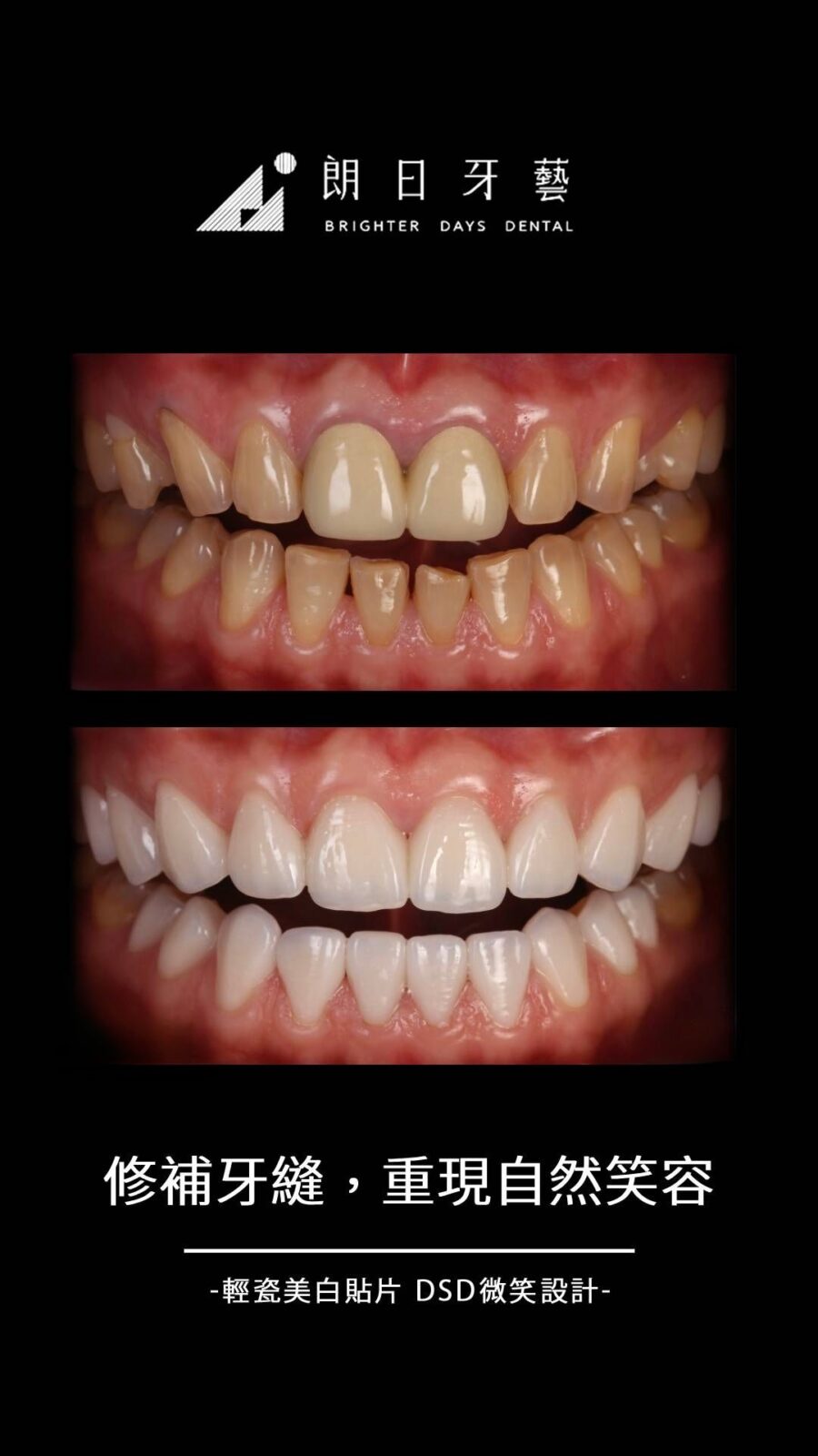 陶瓷貼片案例-牙齒縫隙-台中朗日牙藝-輕瓷美白貼片