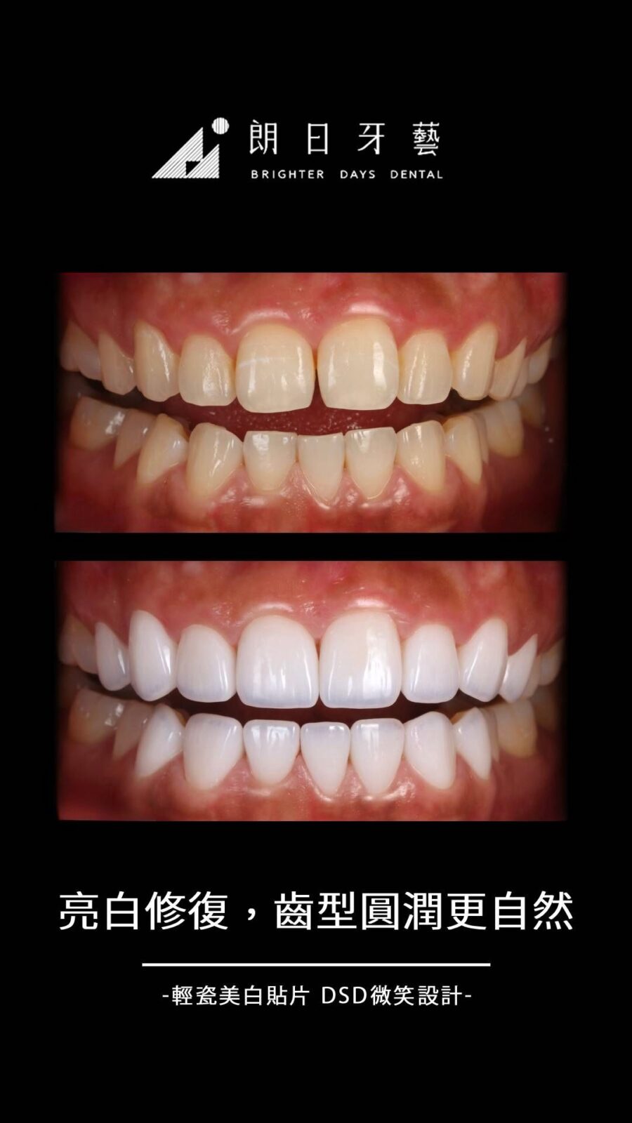 陶瓷貼片案例-門牙有縫-台中朗日牙藝-輕瓷美白貼片