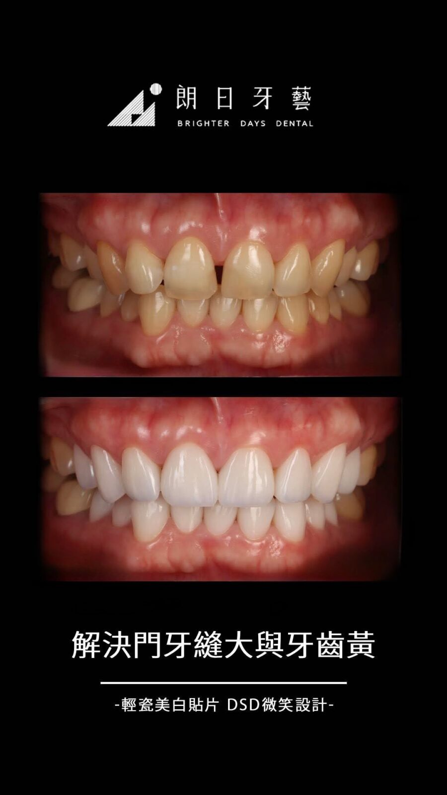 陶瓷貼片案例-門牙牙縫大-牙齒黃-台中朗日牙藝-輕瓷美白貼片