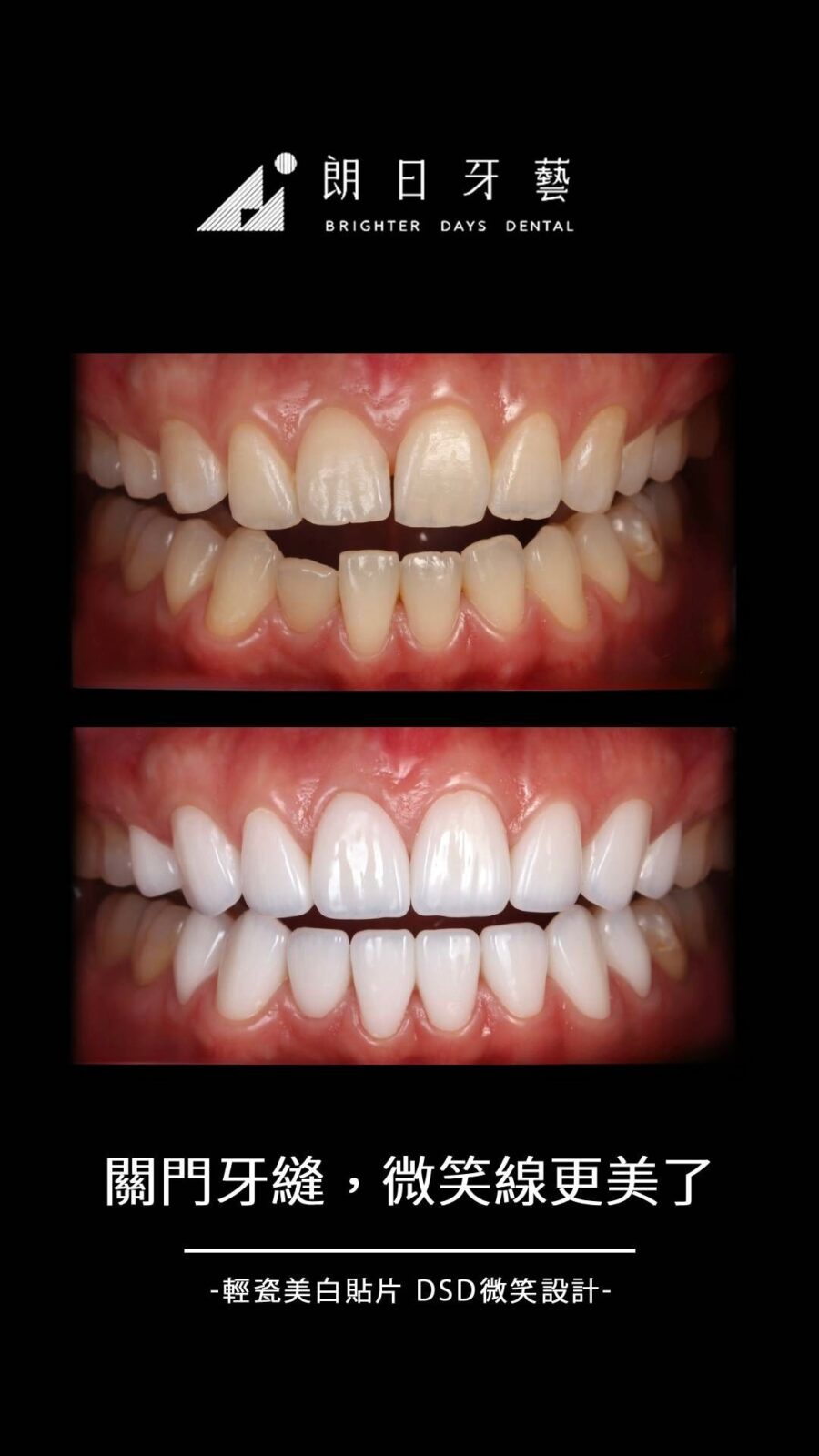 陶瓷貼片案例-門牙縫隙-台中朗日牙藝-輕瓷美白貼片