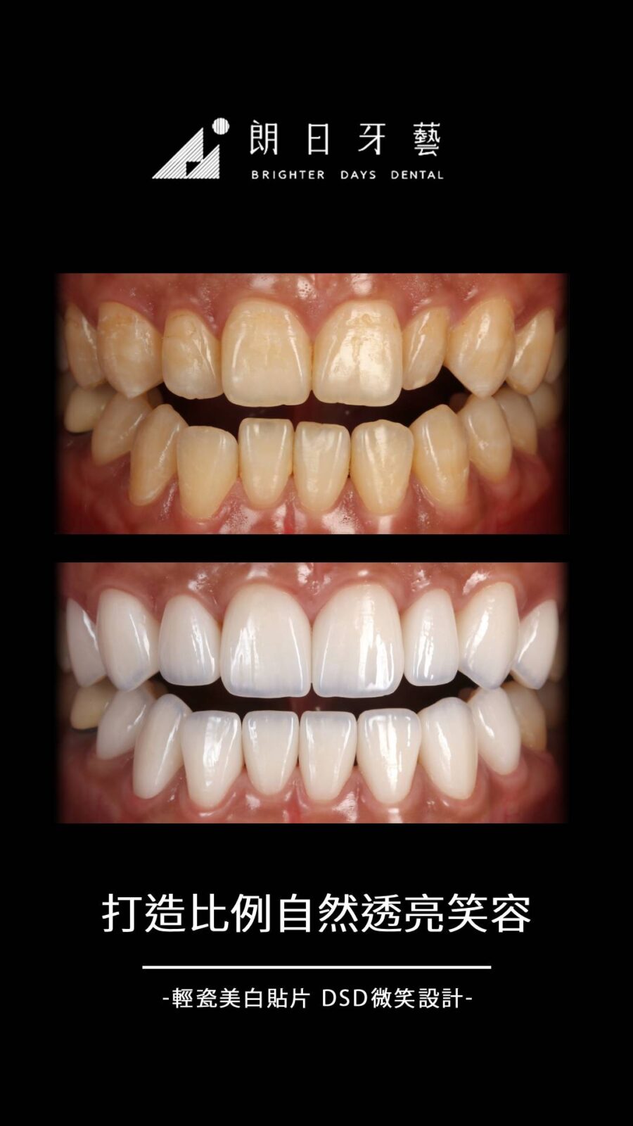 陶瓷貼片案例-齒列不協調-牙齒顏色不均-台中朗日牙藝-輕瓷美白貼片