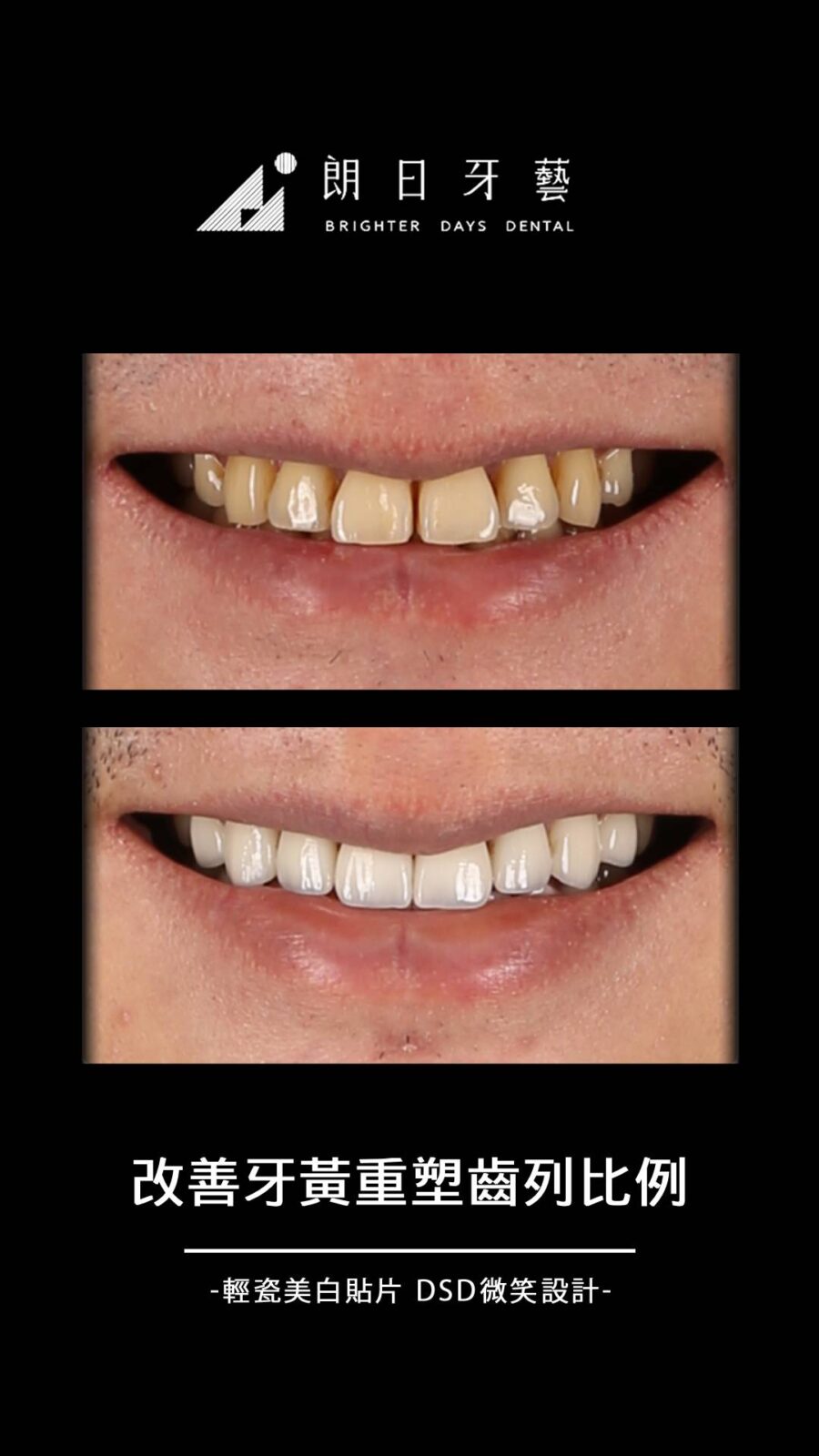陶瓷貼片案例-齒列微亂-牙齒黃-台中朗日牙藝-輕瓷美白貼片