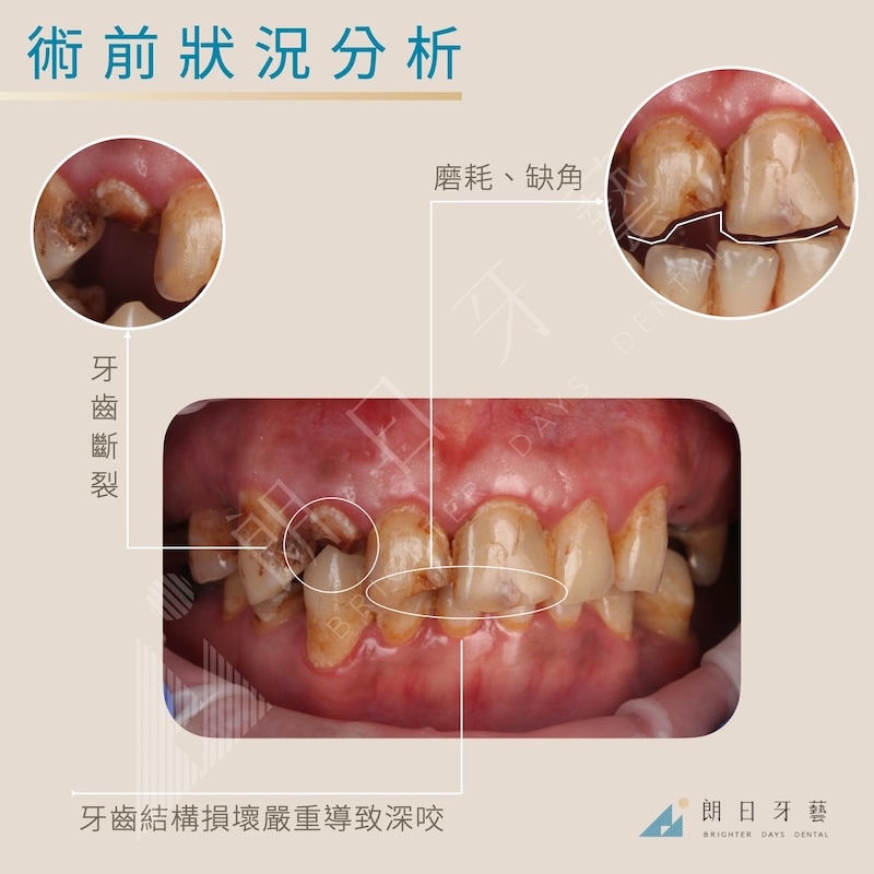 全口墊高術前分析：牙齒嚴重磨耗、缺角與斷裂，咬合高度不足形成深咬，並伴隨蛀牙與舊補綴物變色，影響咬合穩定與外觀