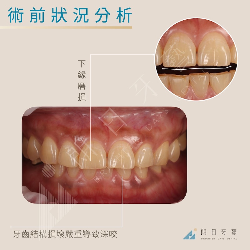 全口墊高術前分析：長期磨牙造成上下牙磨耗與深咬，導致咬合不正與外觀問題
