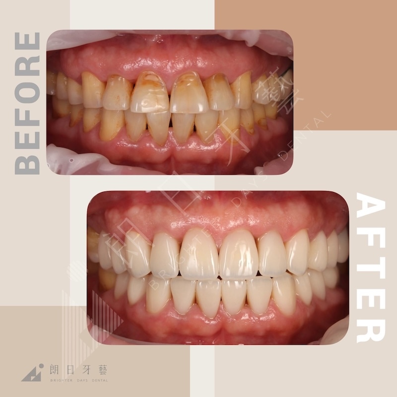 全口墊高治療前後對比：改善後牙磨耗與前牙咬合不正，恢復牙齒長度比例與使用舒適度