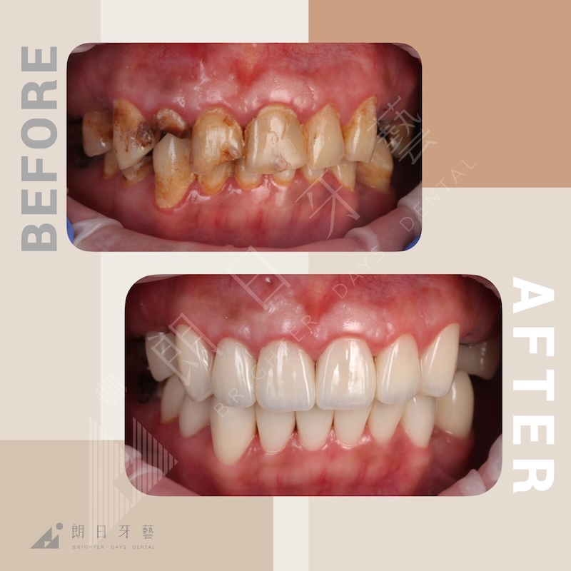 全口墊高治療前後對比：改善深咬、牙齒磨損與缺角，重建穩定咬合與自然笑容比例