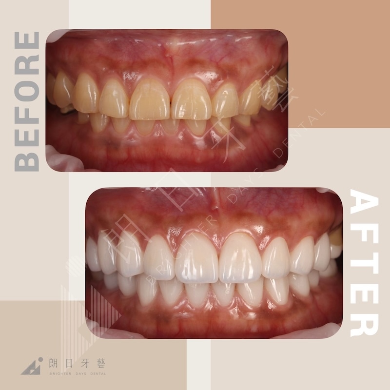 全口墊高治療前後對比：改善深咬與磨耗問題，重建咬合平衡與微笑比例