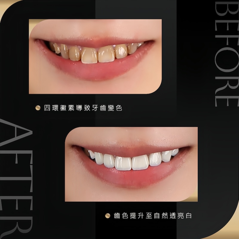 四環素牙治療前後對比:治療前四環黴素染色導致笑容黯淡,經陶瓷貼片美白後,齒色自然透亮,展現自信笑容