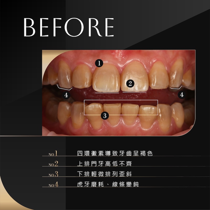 陶瓷貼片療程前,有四環黴素牙齒染色呈褐色、上排門牙高低不齊、下排牙齒微歪斜與虎牙磨耗等問題