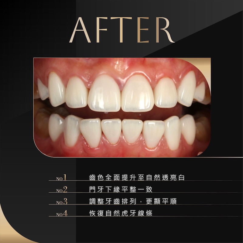 陶瓷貼片改善四環黴素牙齒染色,提亮齒色並調整牙齒排列,門牙下緣平整、虎牙線條自然,打造透亮白的自然笑容
