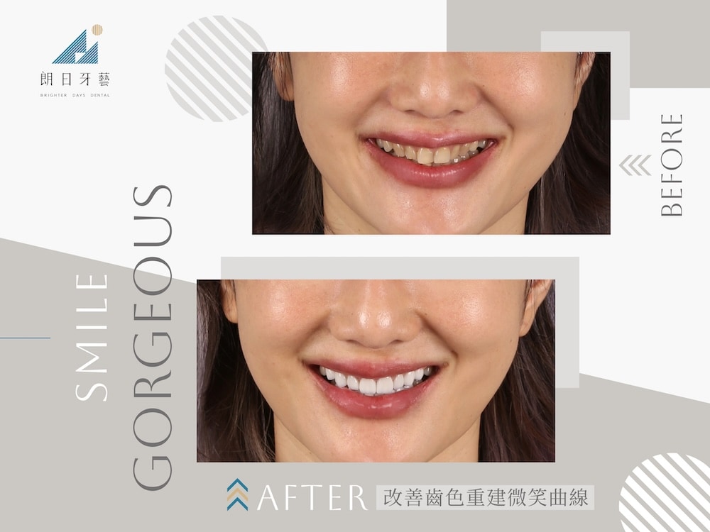 陶瓷貼片改善齒色沉澱並重建微笑曲線，牙齒排列與美白同步完成的案例對比圖