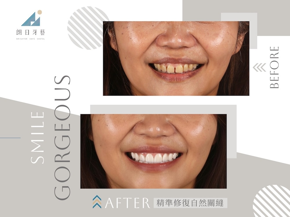 陶瓷貼片精準修復牙縫與齒色差異，重建自然的微笑曲線案例對比圖