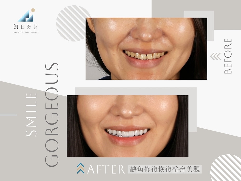 陶瓷貼片改善牙齒缺角與齒列不整，打造協調自然笑容的案例對比圖