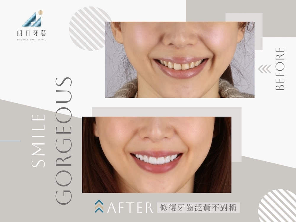 陶瓷貼片修復牙齒泛黃與不對稱問題，打造亮白整齊的自然笑容案例對比圖