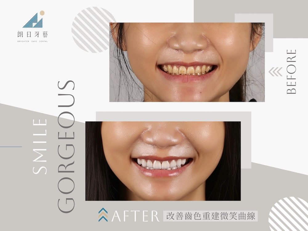 陶瓷貼片改善齒色不均，重建微笑曲線與整體微笑曲線美感的案例對比圖