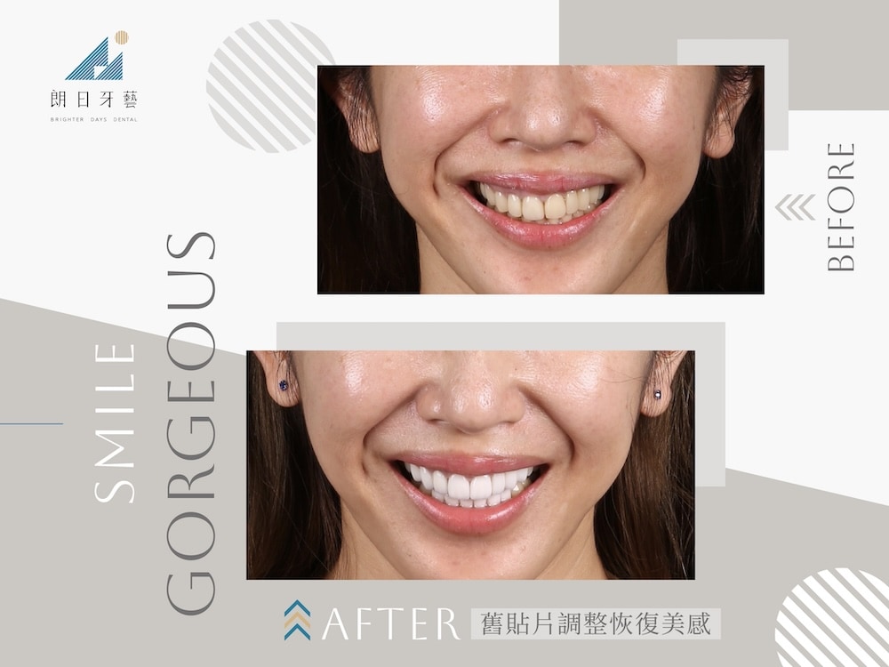 拆除舊貼片重做陶瓷貼片，調整齒型與色階，恢復整齊美觀的牙齒外觀案例對比圖