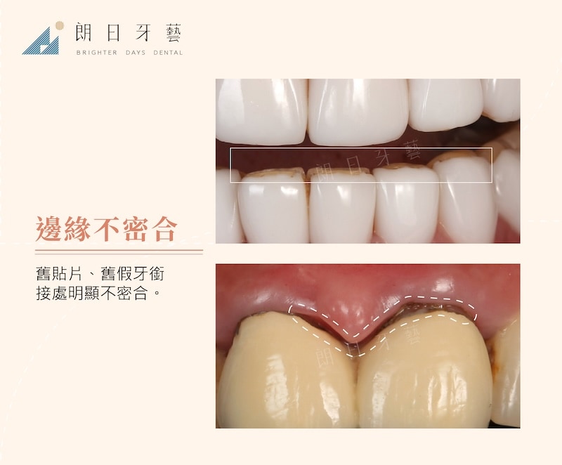 舊假牙及貼片銜接處不密合示意圖