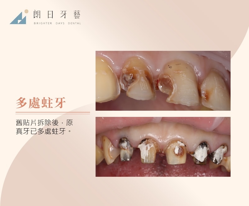 舊貼片拆除後發現多處蛀牙示意圖