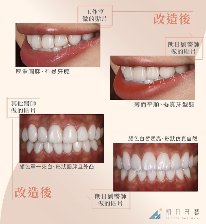 舊貼片顏色形狀不自然，經朗日改造重做後假牙仿真自然、色澤白皙透亮