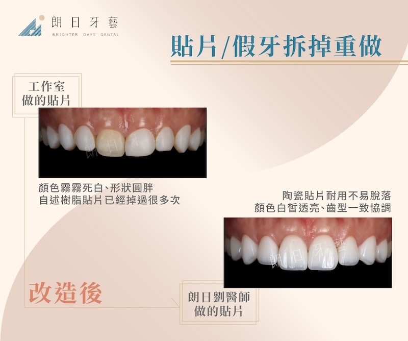 舊樹脂貼片顏色死白且多次掉落，經拆除重建陶瓷貼片後改善色澤與比例