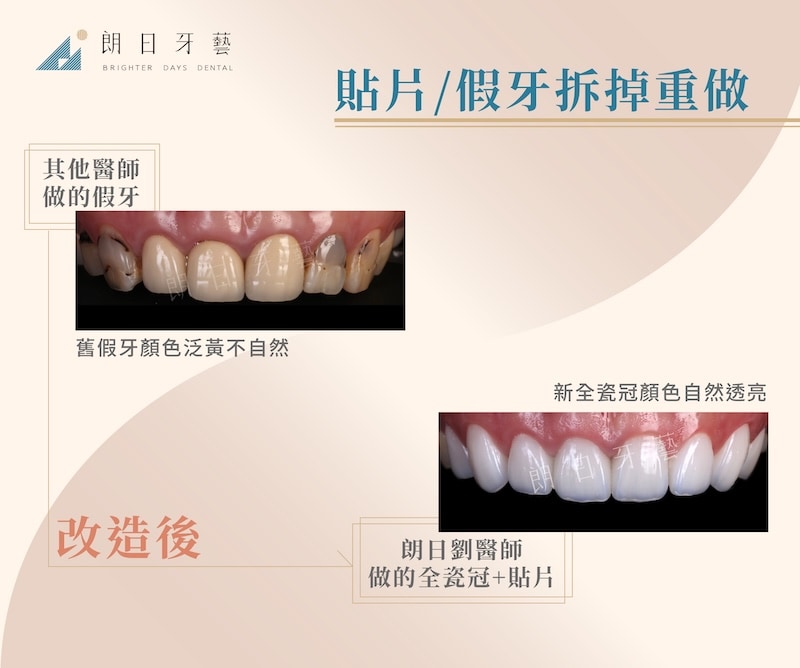 舊假牙顏色泛黃且不自然，重做新全瓷冠與貼片，呈現自然亮白的全瓷美學