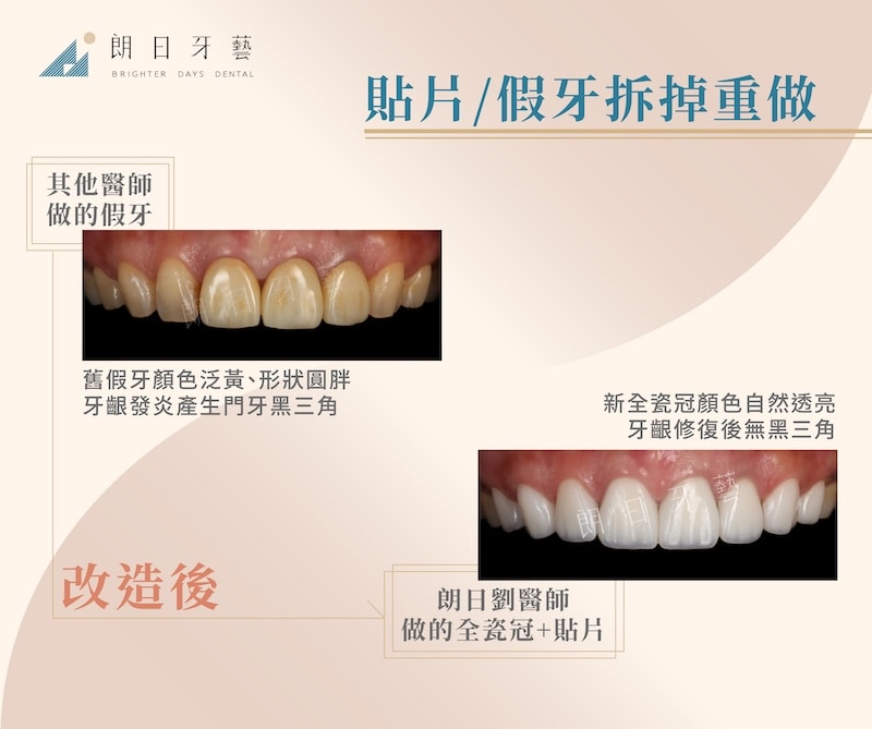 舊假牙顏色泛黃且牙齦發炎，重做全瓷冠與貼片後恢復自然透亮的笑容