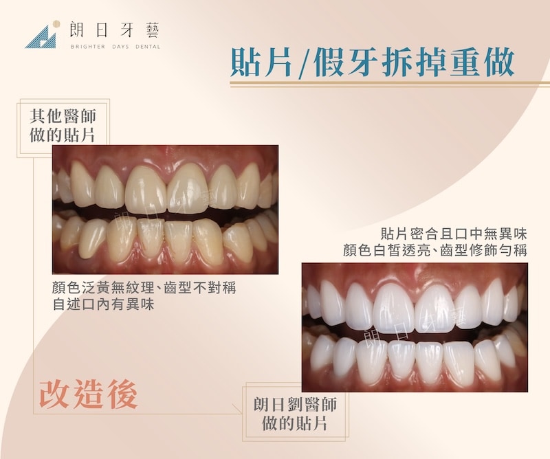 舊貼片齒色泛黃且齒型不對稱，經貼片拆除重建後呈現自然協調齒色