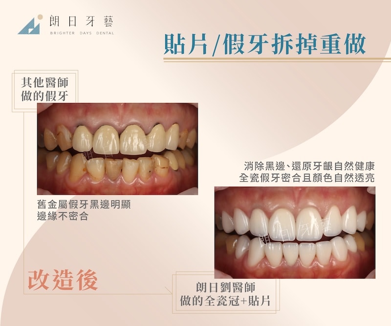 舊假牙顏色黃、黑邊明顯且邊緣不密合，假牙重做後恢復自然齒色與牙齦美觀