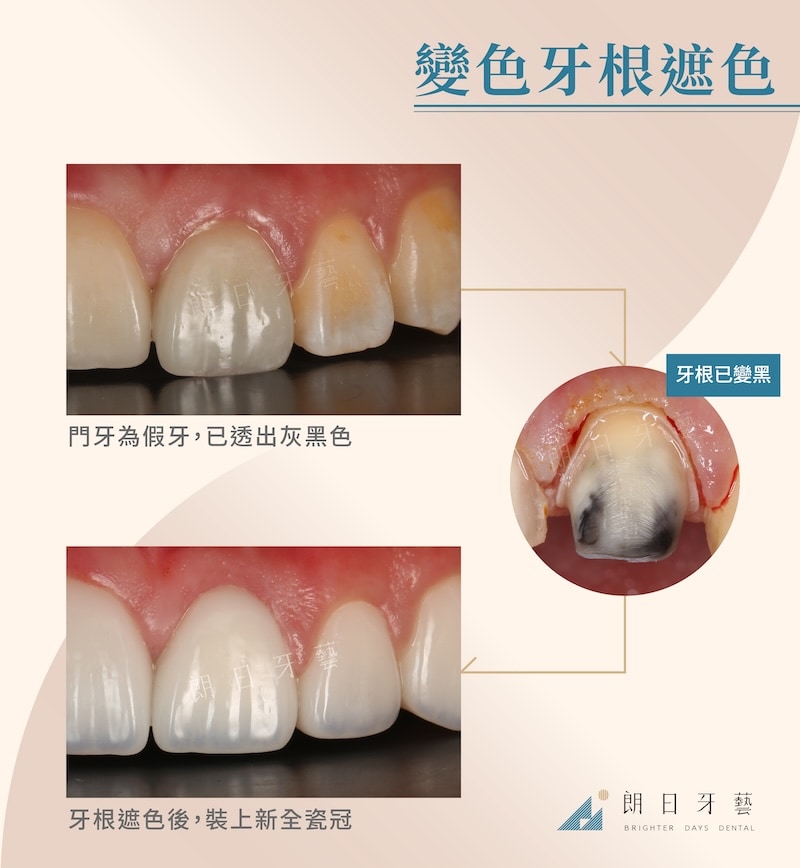 舊門牙假牙牙根變黑，經遮色處理與全瓷冠重建後還原白皙透亮色澤